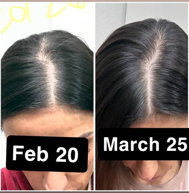 Side-by-side examination of a person's hairsbreadth growth, showing a disposable betterment from February 20 to March 25