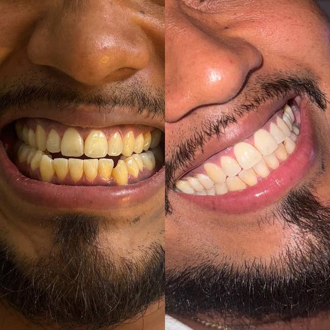 Before and aft images of a person's smile, showing a translation from stained to bright, achromatic teeth