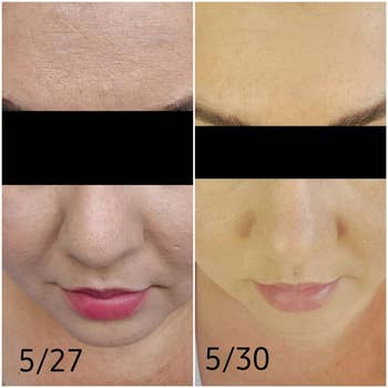 split image of a reviewer before and after using the face spatula, skin is clearer three days after
