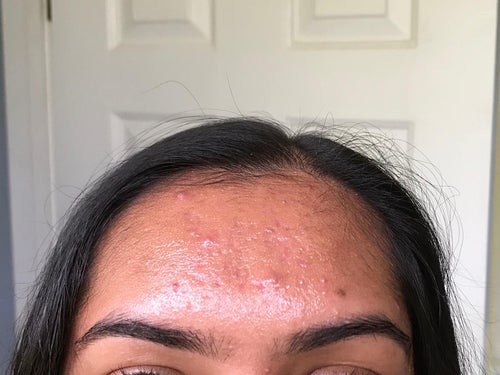 A reviewer's forehead, a bit oily before using blotting sheets