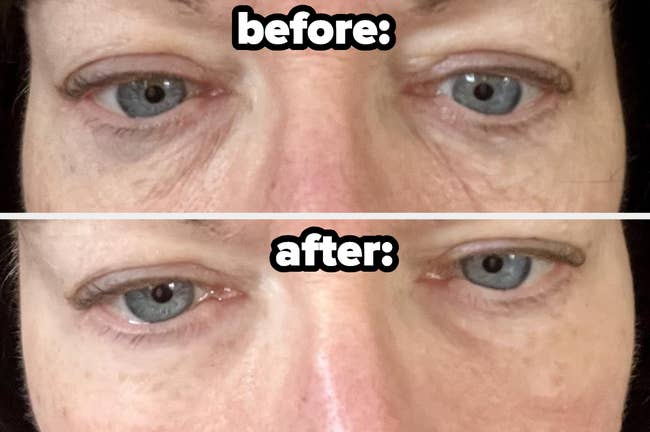 reviewer before and after using the product and their puffy under-eye bags are totally gone