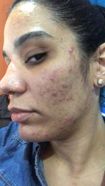 A close-up of a person's look   showing acne and blemishes, wearing a denim overgarment   and stud earrings