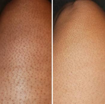 near  shows disposable   tiny  bumps, close    shows smoother skin