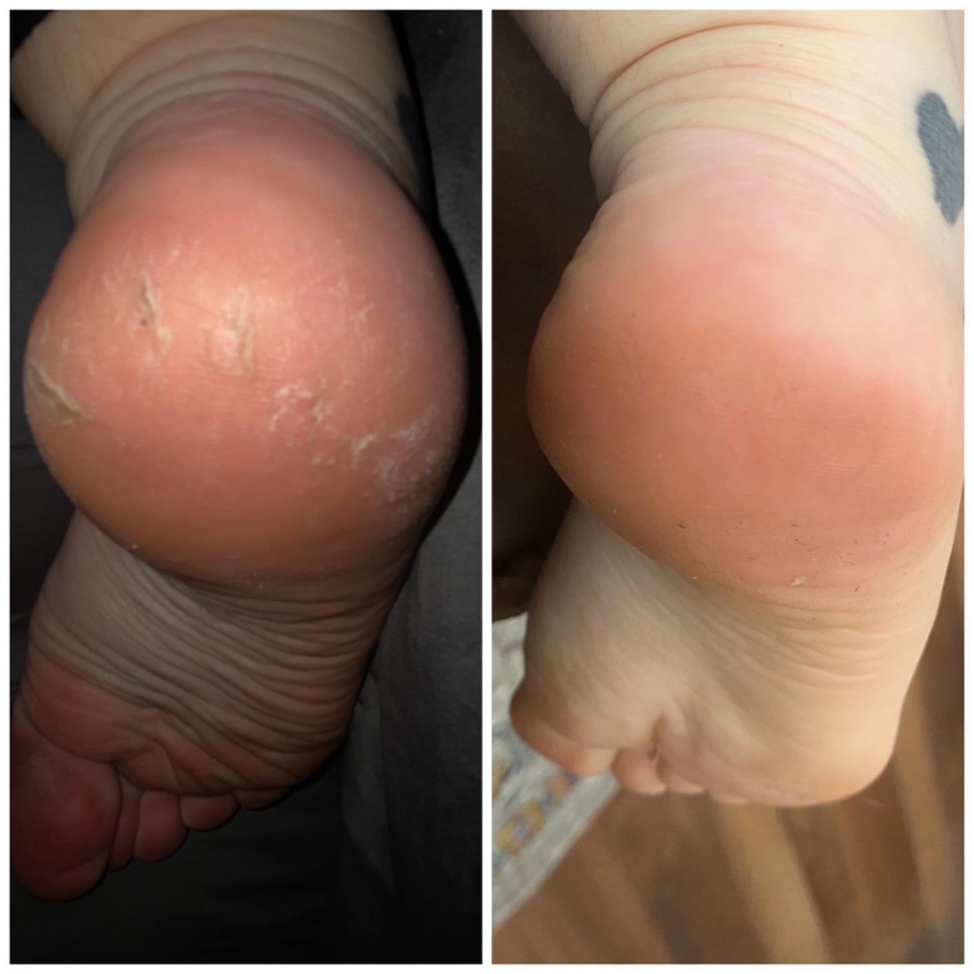 Reviewer showing before-and-after results of using Kerasal Intensive Foot Repair