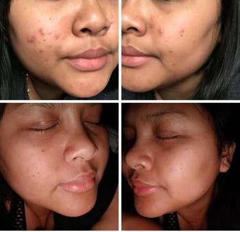 Reviewer's before and after showing reduced acne scars and smoother skin