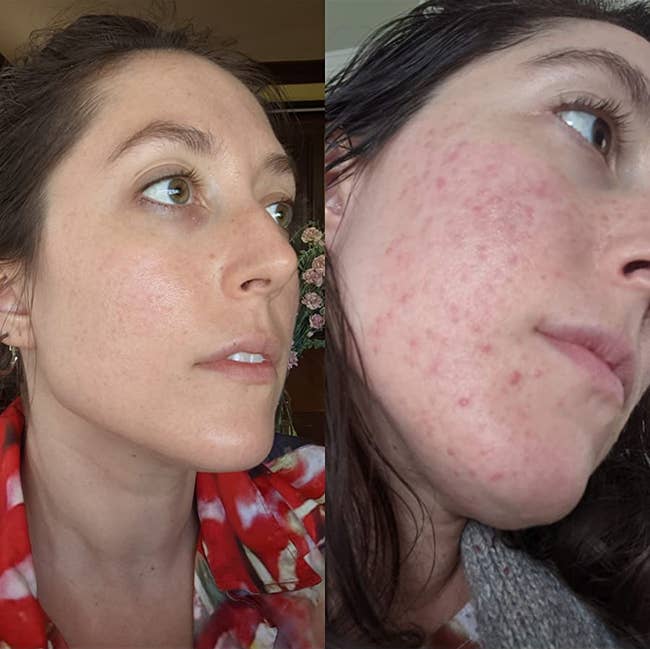 before and after image of a reviewer's acne-ridden face clearing up