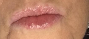 same reviewer after using lip balm