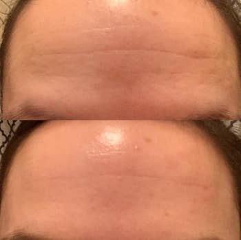 A reviewer's forehead before with wrinkles and after with them less noticeable 