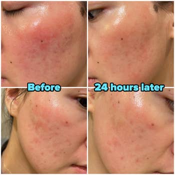 Side-by-side examination  of tegument  redness earlier  and 24 hours aft  utilizing a product