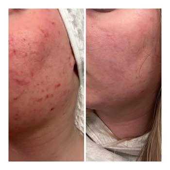 Before and after comparison of a person's red and pimpled skin clearing up