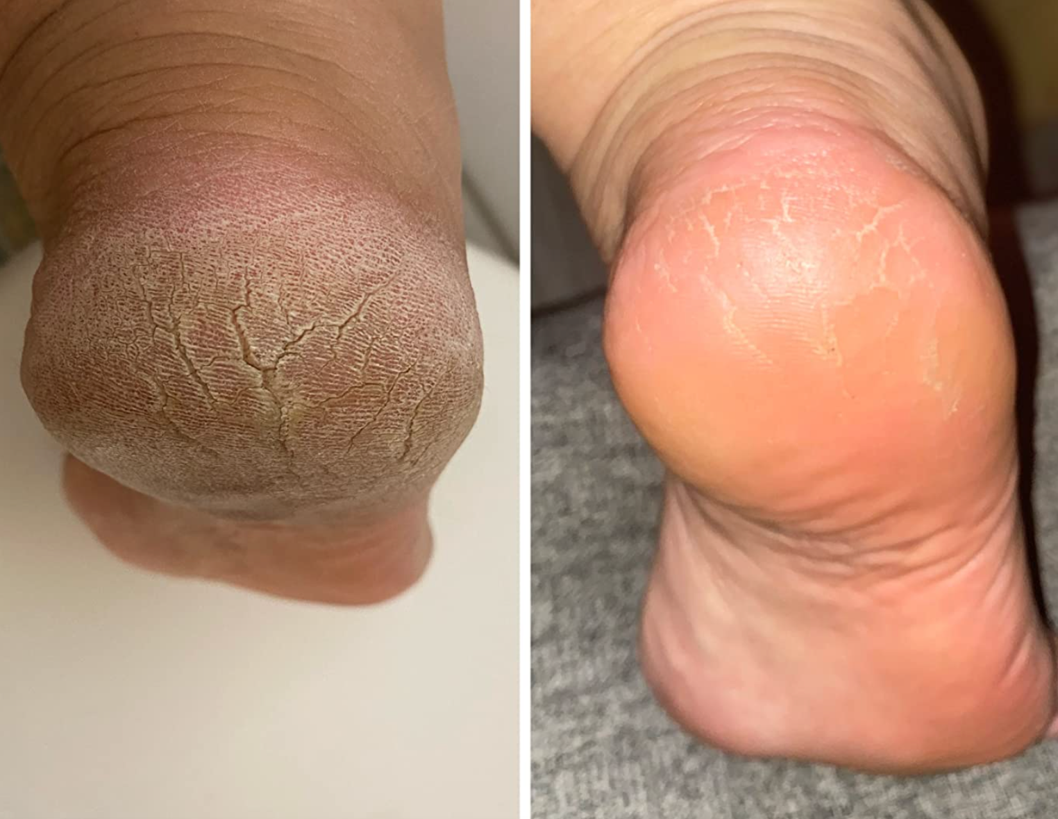 before and after photo of a reviewer's foot for the foot file