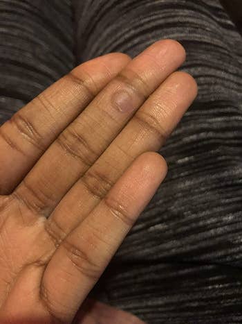 after image of the same reviewer with no wart on finger