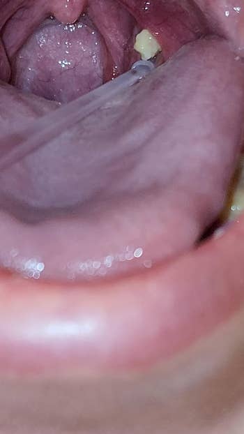 image of inside reviewer's mouth where a tonsil stone rests in the back of their mouth