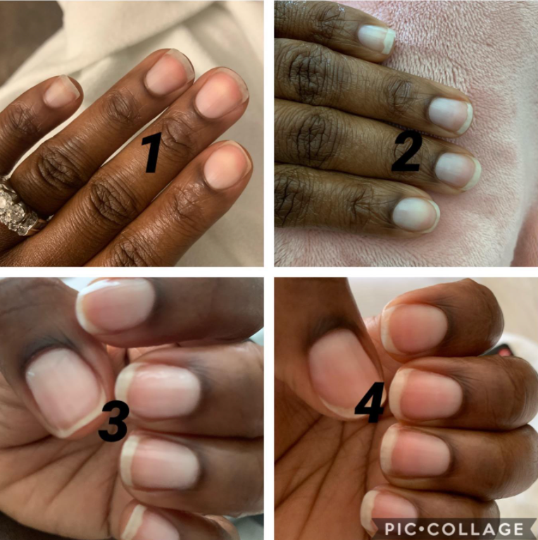 person with brittle nails that become healthier over tim