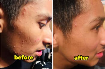 Side-by-side image showing a skincare before-and-after: Left shows acne, right shows clearer skin