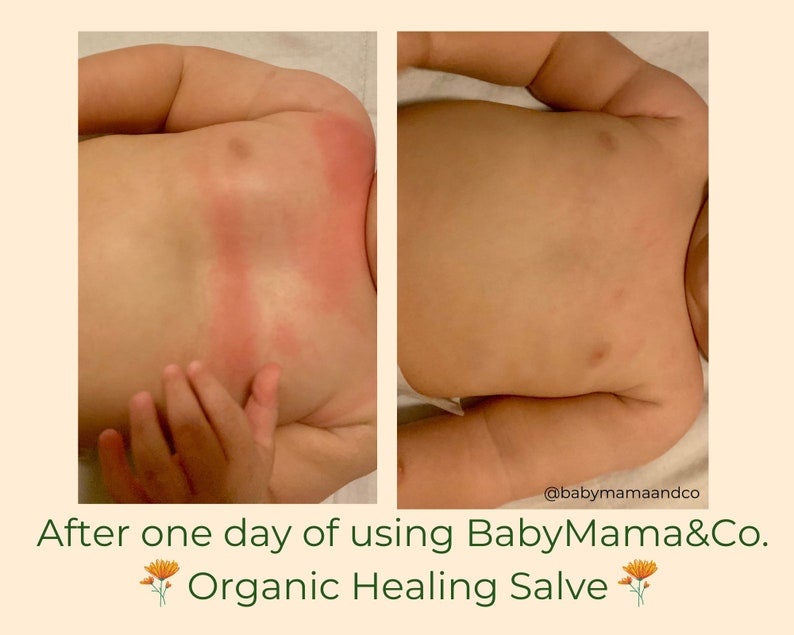 before and after images of a baby's chest covered in a rash that goes away