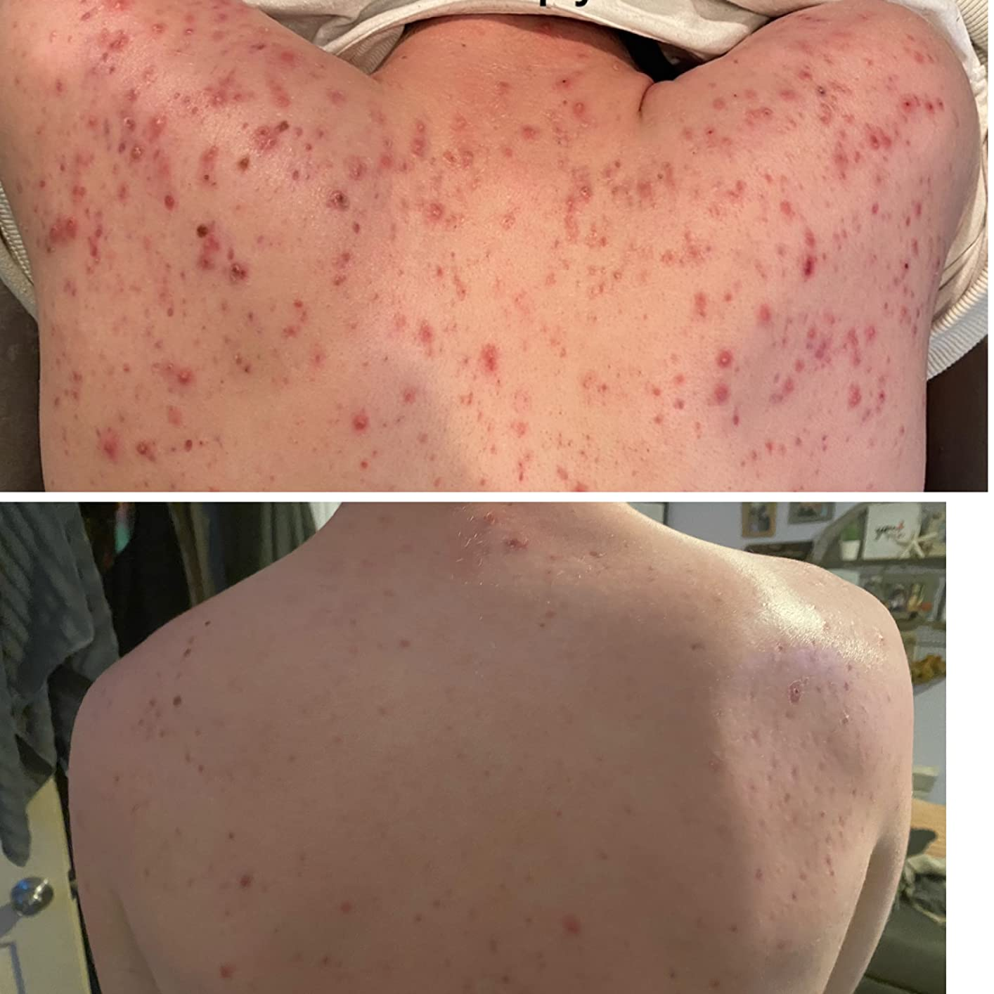 before and after of reviewer's back showing dramatically less acne and redness