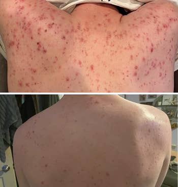 before and after of reviewer's back showing dramatically less acne and redness