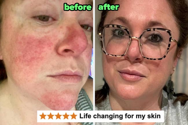 a reviewer with redness earlier and aft utilizing the essence