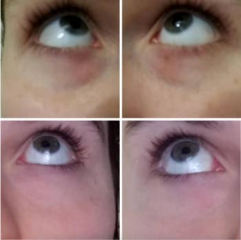 Before and after of reviewer with dark under eyes that are then gone 