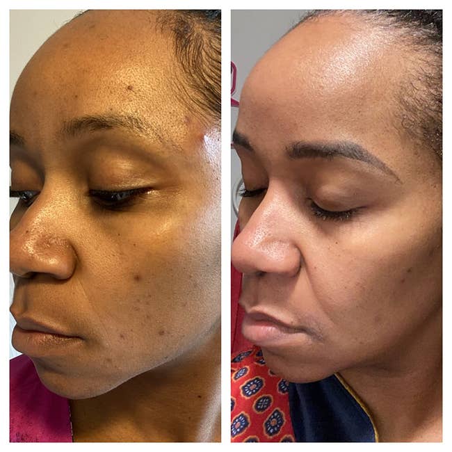 Before and after photos of a person's skin treatment, showcasing clear skin improvement