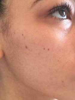 the same reviewer with almost all of their acne scars faded and totally not noticeable