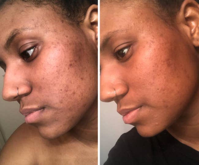 a reviewer before and after showing how the exfoliant has helped reduce blemishes and brighten their skin