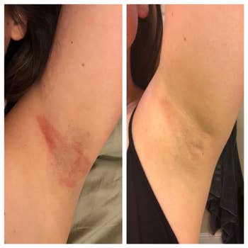 Before and after images of an underarm with improved skin condition, showing reduced redness and discoloration