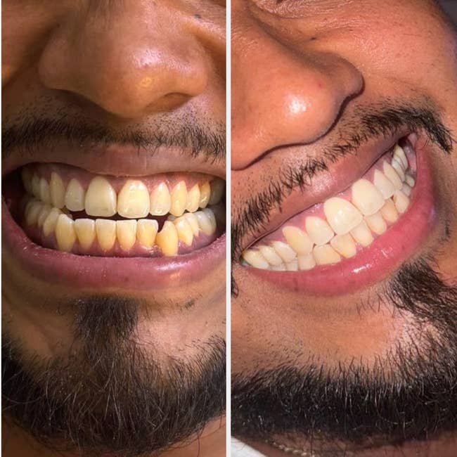 Close-up of a man before and after teeth whitening, showing a dramatic improvement in brightness and color of teeth
