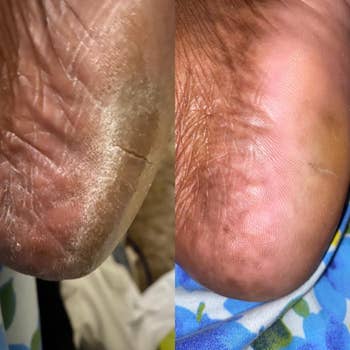 Close-up examination of a dry, cracked bottommost earlier and aft treatment. The aft representation shows a smoother, much moisturized heel