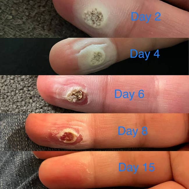 reviewer showing their wart slowly going away over 15 days of using Compound W