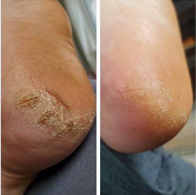 Reviewers feet showing dried and cracked heels/reviewers feet looking much  moisturized and little  cracked
