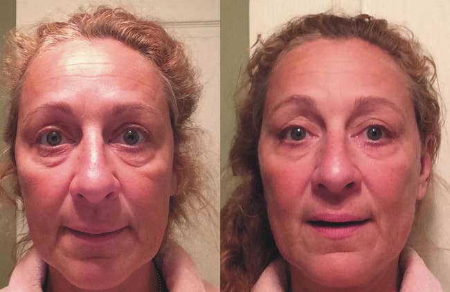 reviewer before and after using the serum and you can see their skin looks noticeably lifted and wrinkles and fine lines are less noticeable