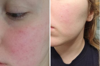 reviewer before and after photo with reduced redness
