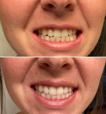 reviewer before and after photos showing their teeth looking much whiter 10 minutes after using the whitening pen