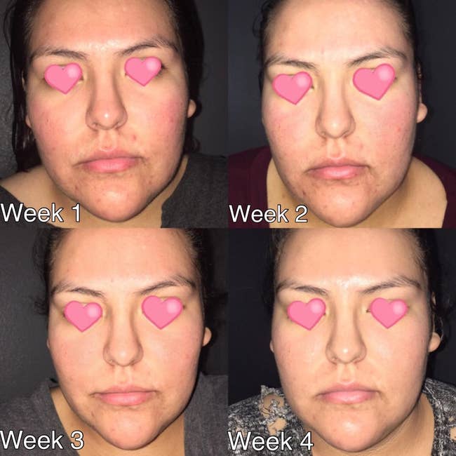 top left to bottom right: four-week progression photo of reviewer with acne on face and less acne spots throughout after using the toner above