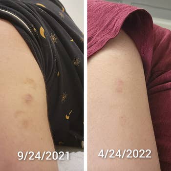 a reviewer's scars on their arm before and after looking much more faded