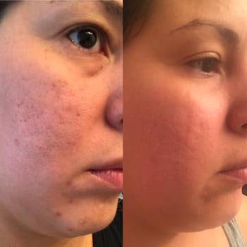 Close-up of a person's look   showing a tegument  transformation. The near  broadside  shows acne and unsmooth  texture, portion    the close    broadside  appears smoother