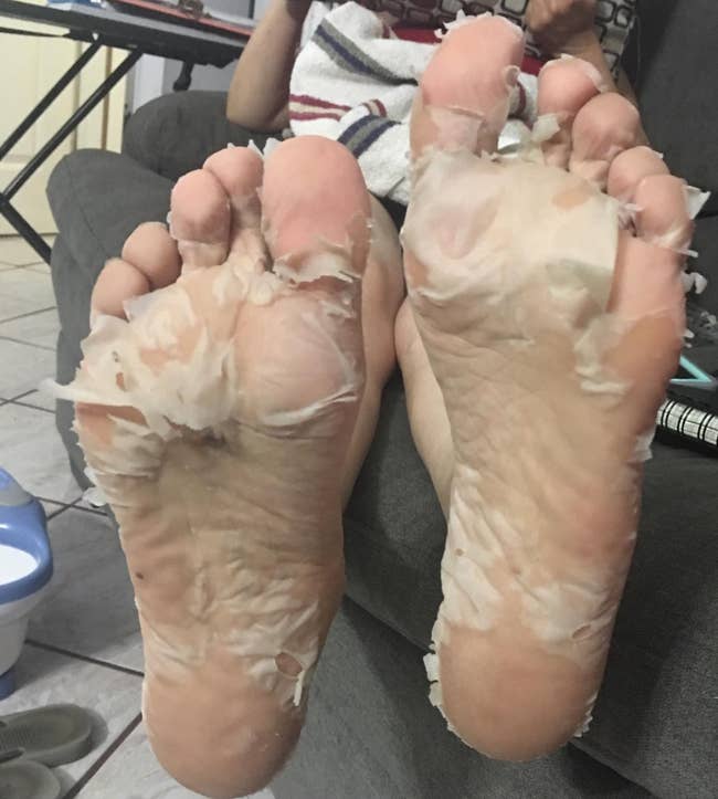 a reviewer's feet peeling
