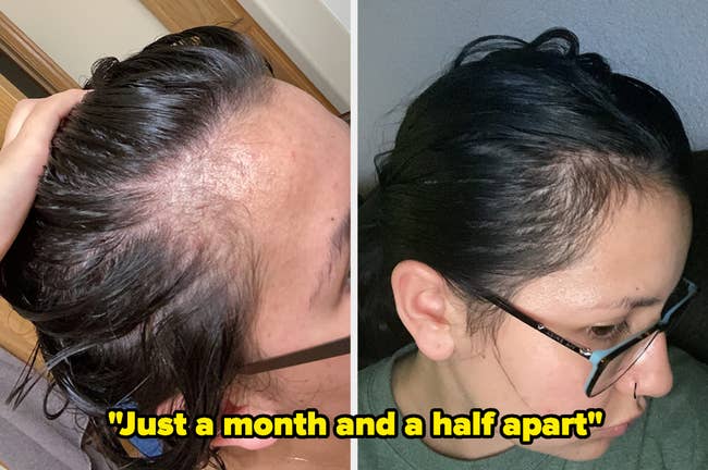 A reviewer thinning hairline before, and filled in a month and a half later