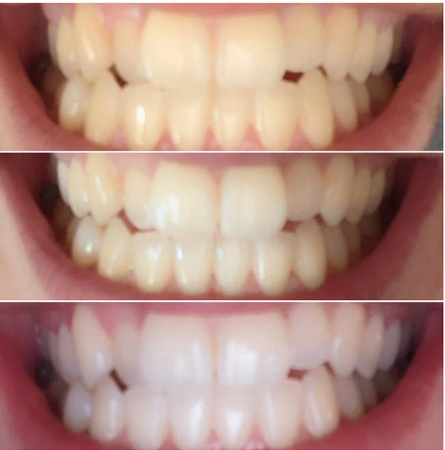 a reviewer's photo of their teeth before, during, and after using teeth whitening pens 
