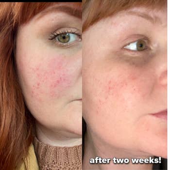 reviewer before and after with reduced redness, added caption 