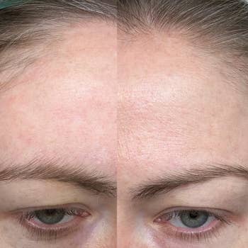 Close-up divided  representation  of a person's forehead showing earlier  and aft  tegument  attraction   effects; creaseless  texture connected  the close    side