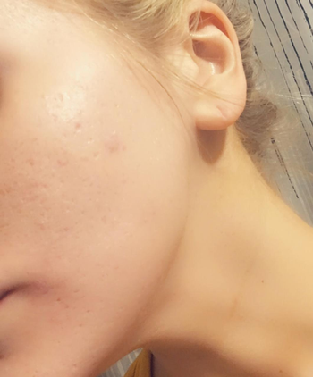 reviewers after showing smooth even skin with minimized acne