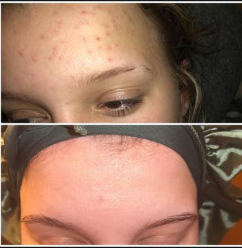 Two before-and-after images amusement   tegument  betterment  connected  a forehead, transitioning from acne-prone to clear