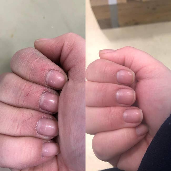 before and after images of a reviewer's dry and cracked hand becoming smooth and moisturized