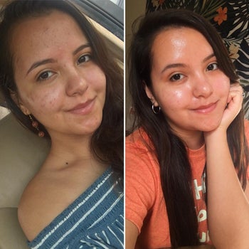 reviewer's before and after, showing their facial acne going away
