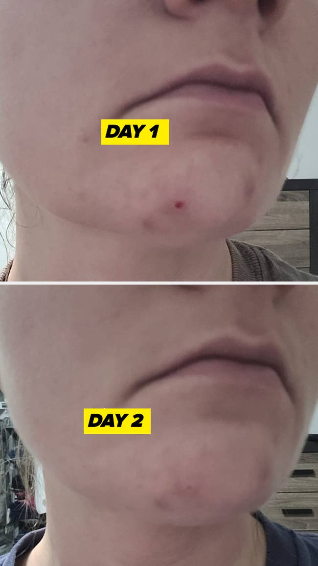 Reviewer on day one of using Rescue Balm, with picked, irritated, and slightly bloody blemishes and on second day with blemishes markedly calmed