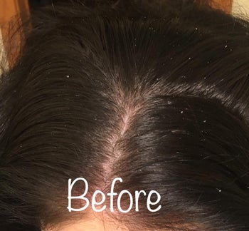 before image of a reviewer's scalp covered in dandruff