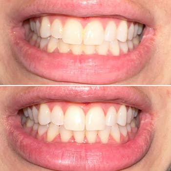 Reviewer's teeth before and after using toothbrush